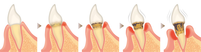 歯周病治療