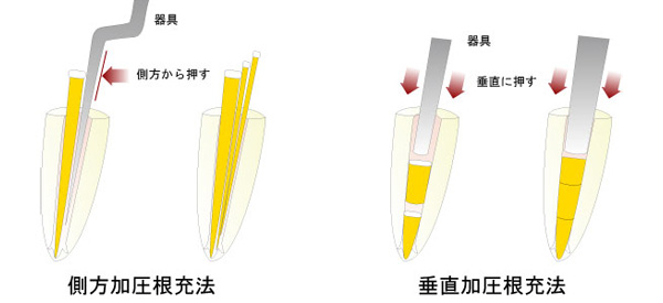 薬を詰める方法