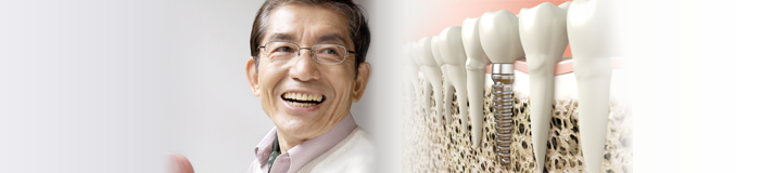 インプラントQ&A